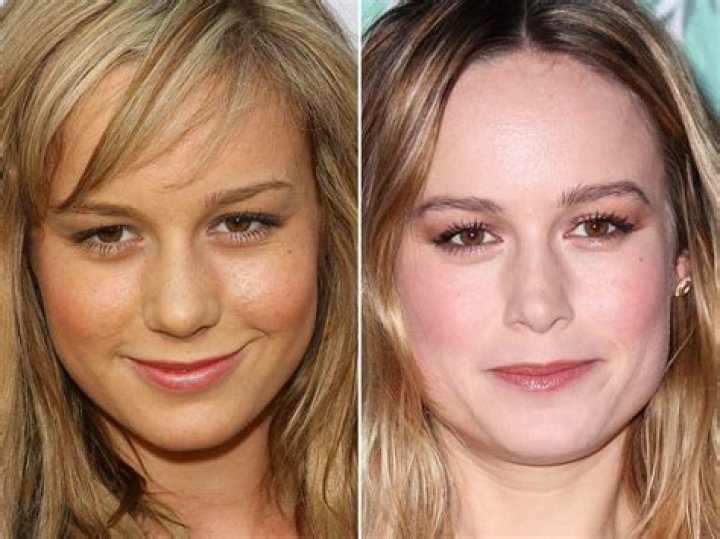Brie Larson Plastic Surgery Before and After