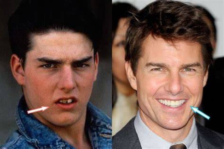 Tom Cruise Plastic Surgery Before and After